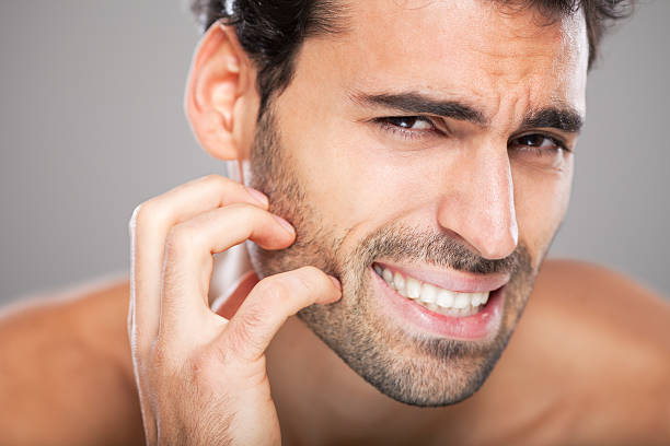 Como evitar pelos encravados na barba